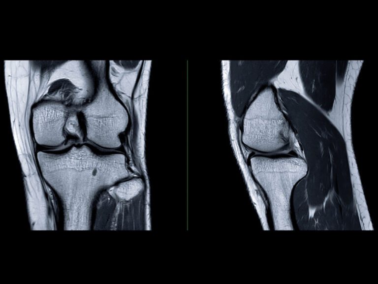 Genicular Artery Embolization Orange County Orthopedic Center