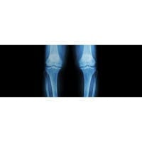 Could You Have Osteoarthritis? - Orange County Orthopedic Center