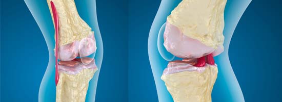 Dealing-with-Osteoporosis-by-Orange-County-Orthopedic-Center