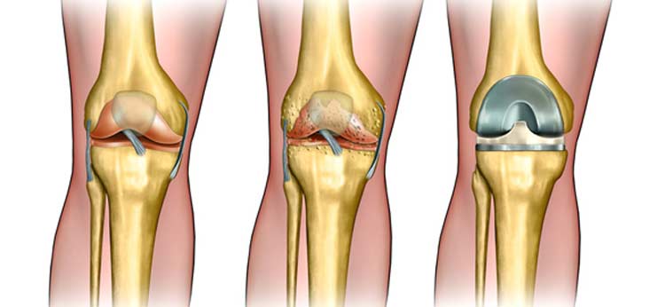Total-Joint-Replacement-Orange-County-Orthopedic-Center