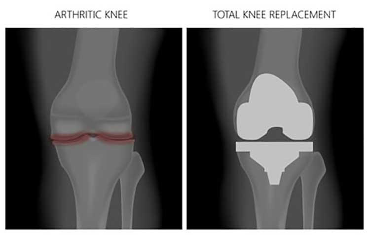 partial-vs-total-joint-replacement
