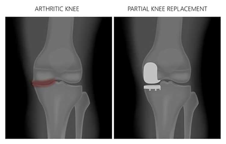 partial-vs-total-joint-replacement