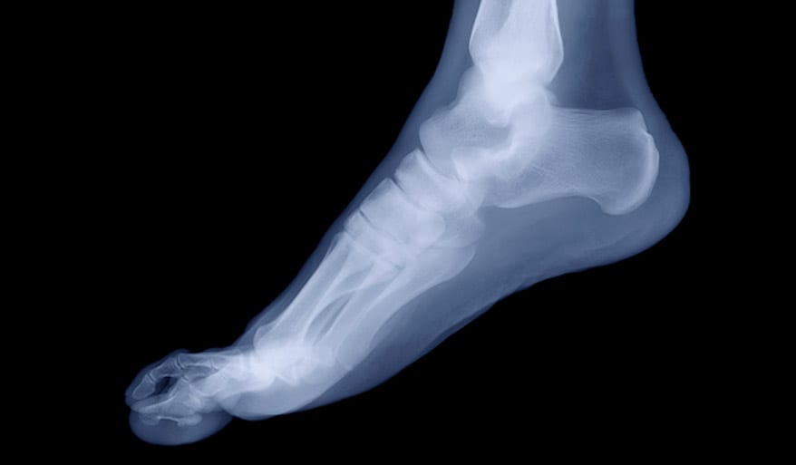 An-x-ray-may-be-performed-to-track-the-progression-of-arthritis