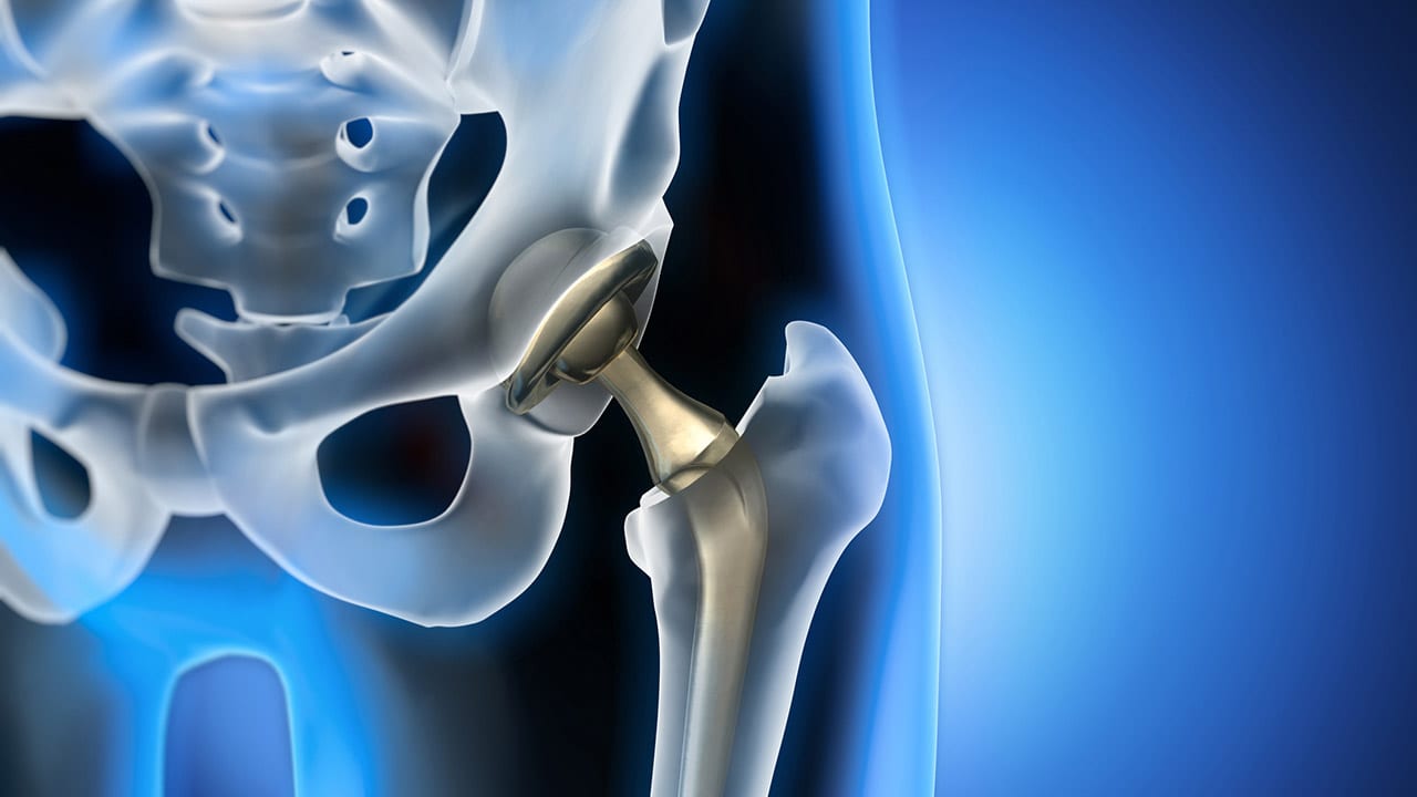 Digital-illustration-of-a-hip-replacement