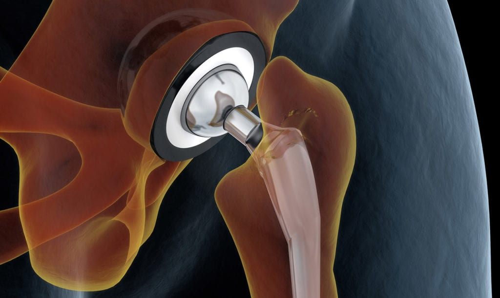 What Does The Total Hip Replacement Recovery Process Look Like   Digital Illustration Of A Hip Replacement 1024x612 