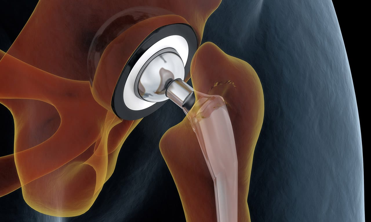 Digital-illustration-of-a-hip-replacement