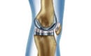 Digital-illustration-of-a-knee-replacement