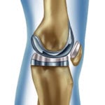 Digital-illustration-of-a-knee-replacement
