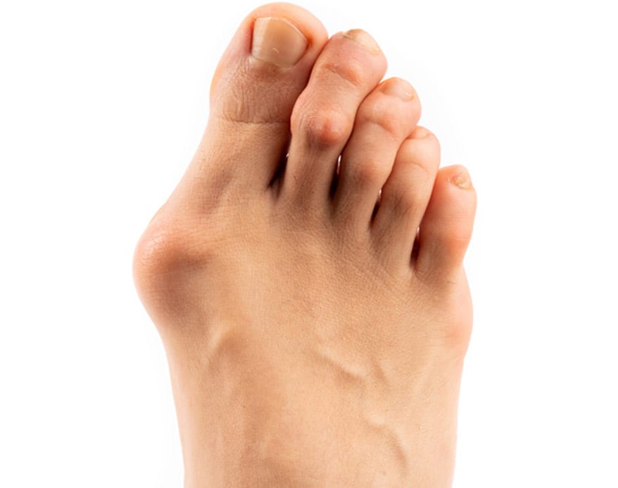 Female-foot-with-bunions