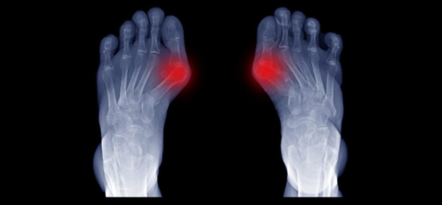 X-ray-of-feet-with-bunions