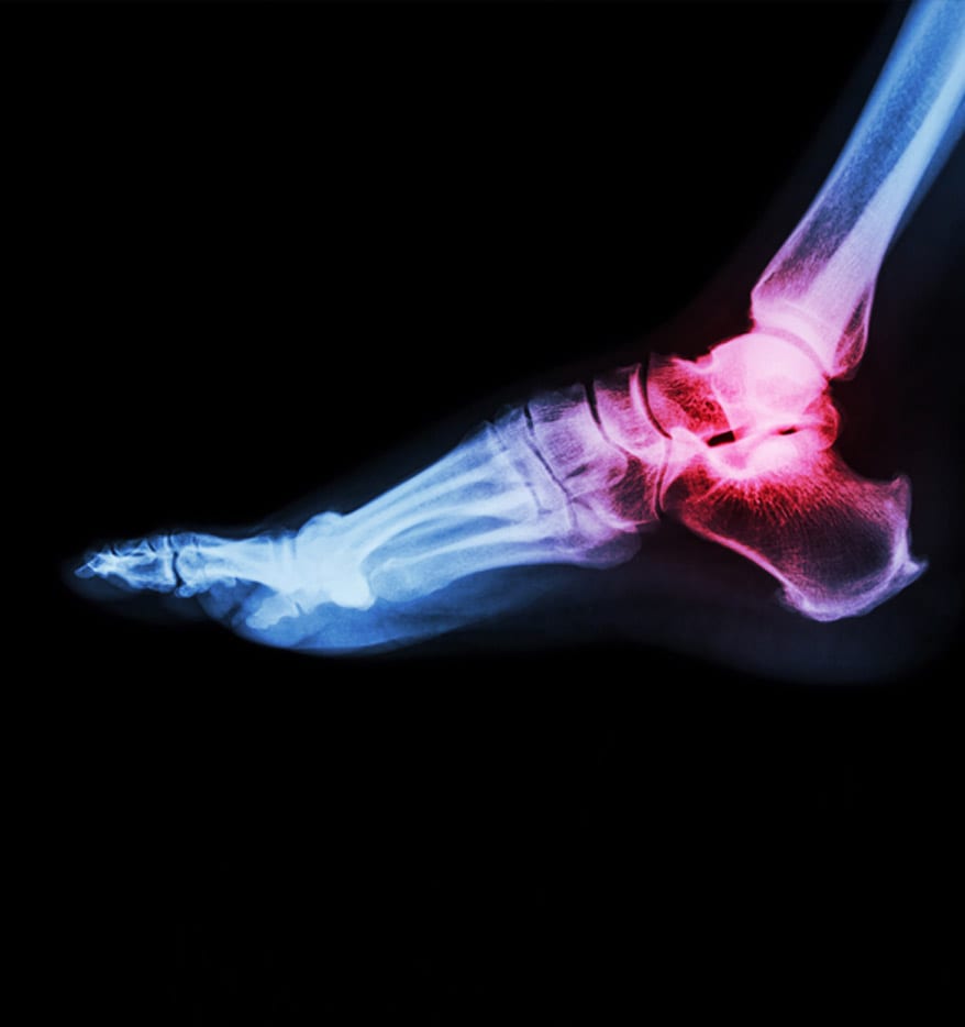 X-ray-scan-of-arthritis-in-the-foot