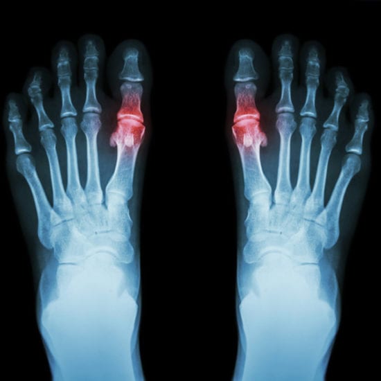 Gout - Orange County Orthopedic Center