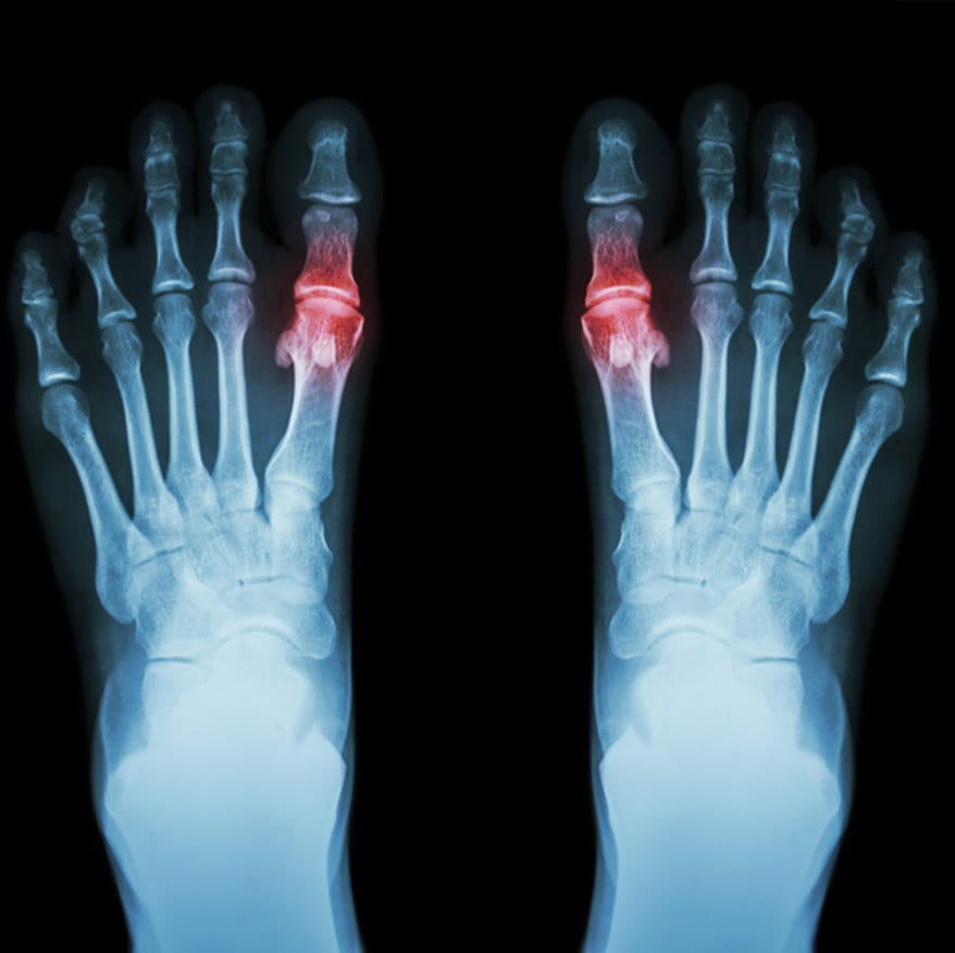 X-ray-scan-of-feet-with-gout