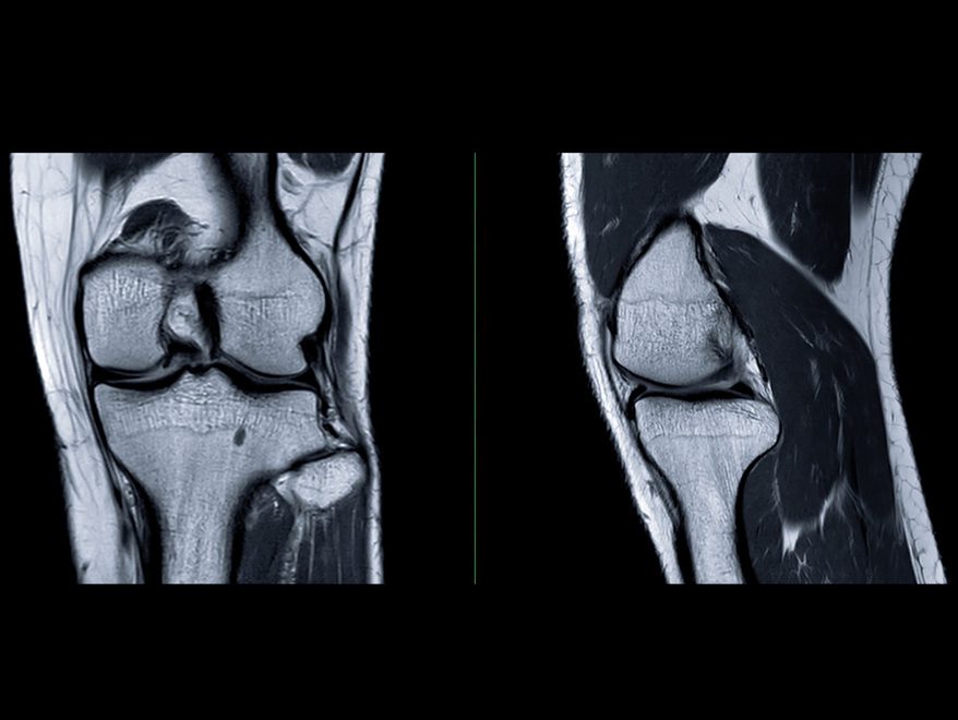 mri-scan-of-knee